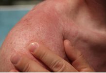 KAKO DA PREPOZNATE ALERGIJU NA SUNCE: Postoji više vrsta, a evo koji su simptomi i kada se javljaju