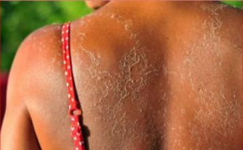 IZGORILI STE NA SUNCU I KOŽA VAM SE LJUŠTI? Probajte ovaj SUPER TRIK, zaboravite na jogurt – OVO ĆE VAS SPASITI