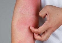 Zašto me tijelo svrbi nakon tuširanja? Ako i vi imate crvene mrlje, evo zašto