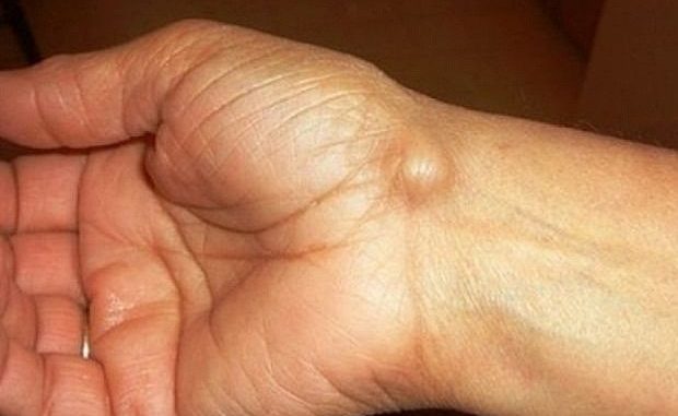 Imate li ovakve IZRASLINE: Evo kako da ih se riješite PREKO NOĆI