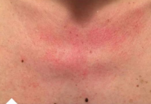 Zašto me tijelo svrbi nakon tuširanja? Ako i vi imate crvene mrlje, evo zašto