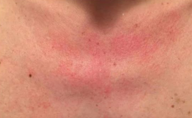 Zašto me tijelo svrbi nakon tuširanja? Ako i vi imate crvene mrlje, evo zašto