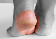 Ispucale pete: Spriječite duboke rane, krvarenje i bol! Evo kako ih liječiti kod kuće