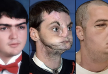 Sa 22 godine, jedno neoprezno čišćenje sačmarice zauvijek mu je uništilo lice – ali ono što će se desiti 15 godina kasnije šokiralo je cijeli svijet!