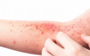 OBRATITE PAŽNJU: Ove promjene na koži mogu ukazivati na problem s jetrom