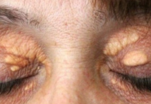 STAVILA SAM OVU NAMIRNICU NA MASNO TKIVO KOD OKA, ono je preko noći nestalo: EVO ŠTA ME SPASILO, SVI GA IMATE U KUĆI