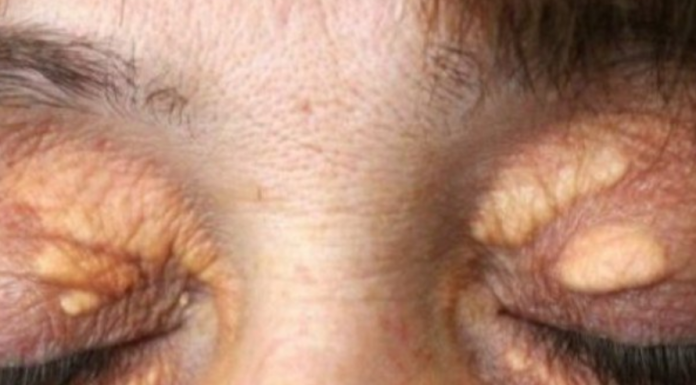 STAVILA SAM OVU NAMIRNICU NA MASNO TKIVO KOD OKA, ono je preko noći nestalo: EVO ŠTA ME SPASILO, SVI GA IMATE U KUĆI